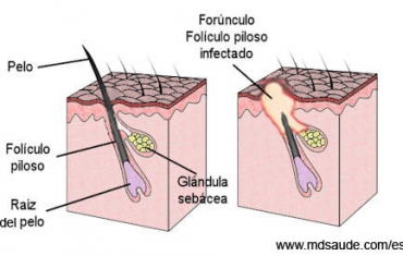 anus condilom vestibular papillomatosis with genital warts